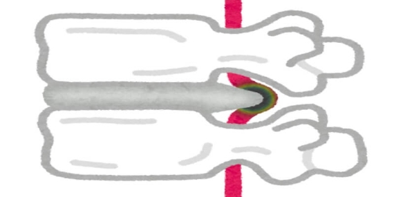 Bel Fıtığı Ameliyatı ve Sigorta Kapsamı: MR Görüntüleme Hakkında Bilinmesi Gerekenler